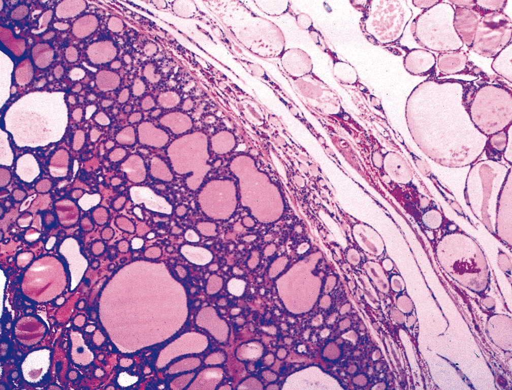 Pathology Outlines Follicular Adenoma